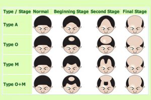 Male-Pattern-Hair-Loss1